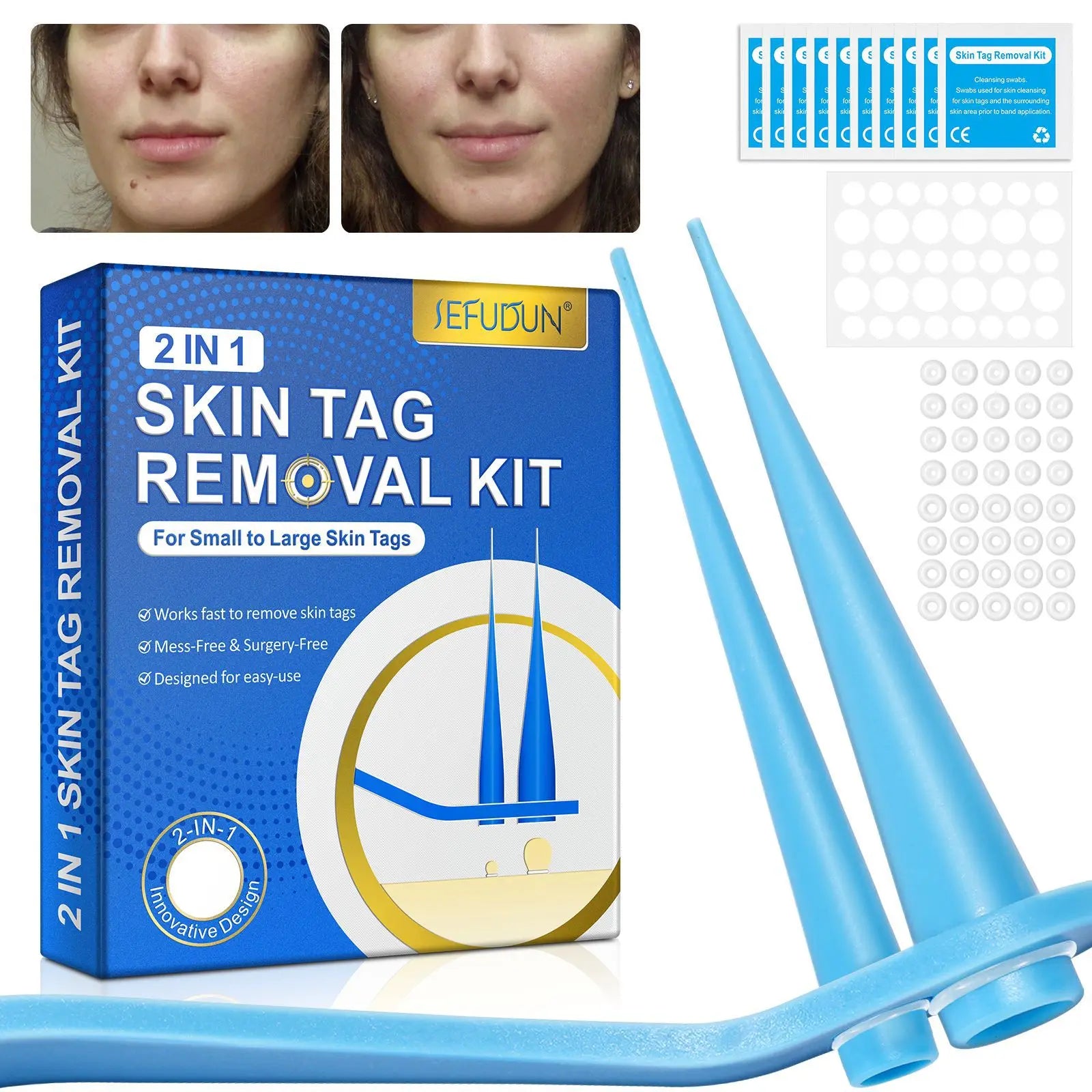 2 In 1 Auto Skin Tag Removal Kit Painless Mole Wart Remover Equipment Micro 2-9mm Treatment Tool Easy To Clean Skin Care Tool