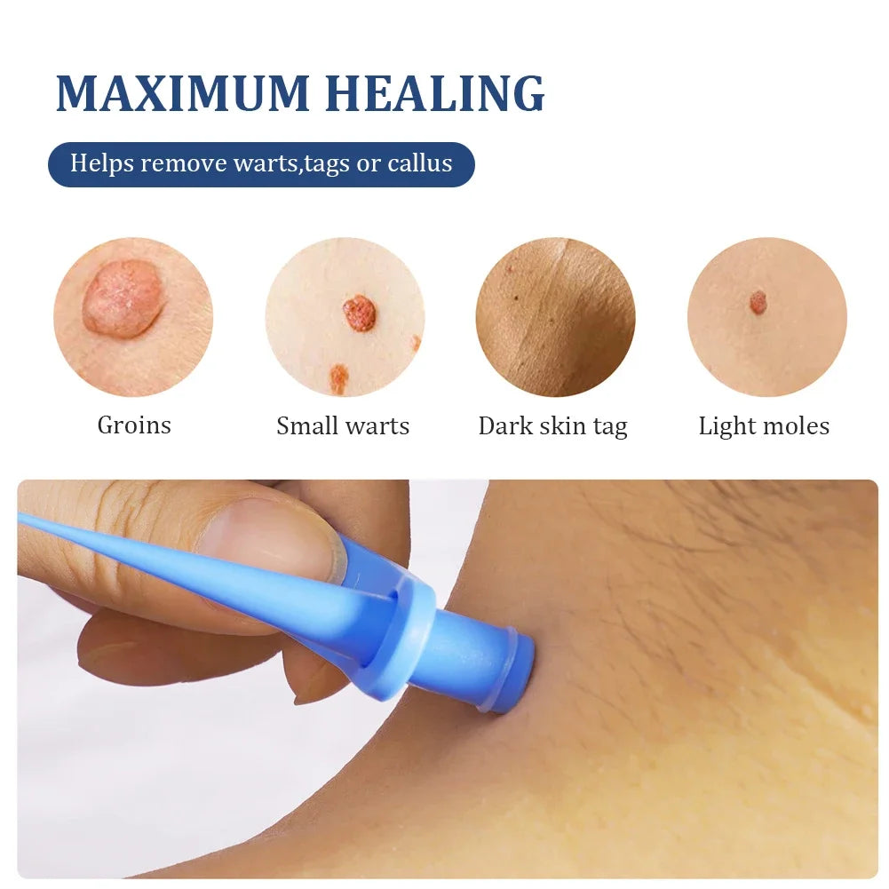 2 In 1 Auto Skin Tag Removal Kit Painless Mole Wart Remover Equipment Micro 2-9mm Treatment Tool Easy To Clean Skin Care Tool