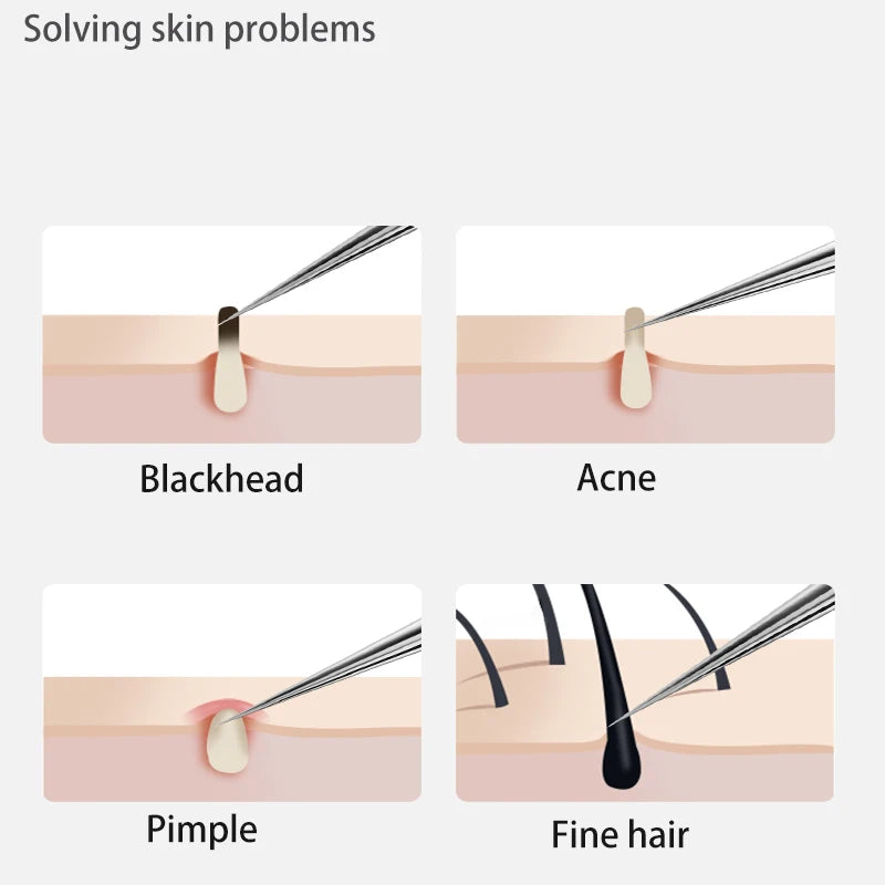 Pimples Blackhead Clip Blackhead Remover Tools Acne Extractor Needles Kit Face Skin Care Tool Black Dots Cleaning Tweezers